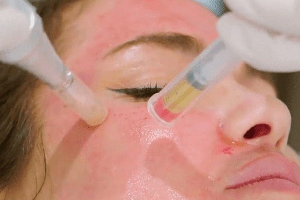 PRP-Microneedling_post_1024x720